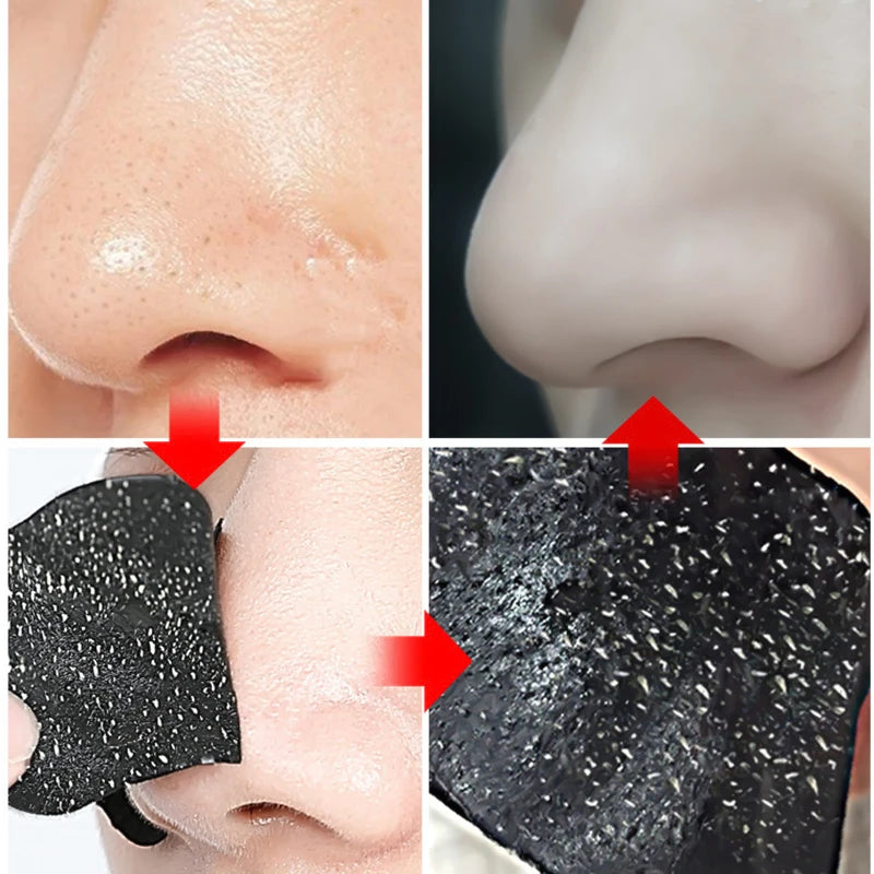 Nose Strips Blackheads & Acne Removal