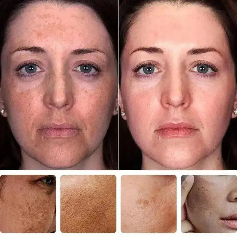 Whitening Freckles Face Cream