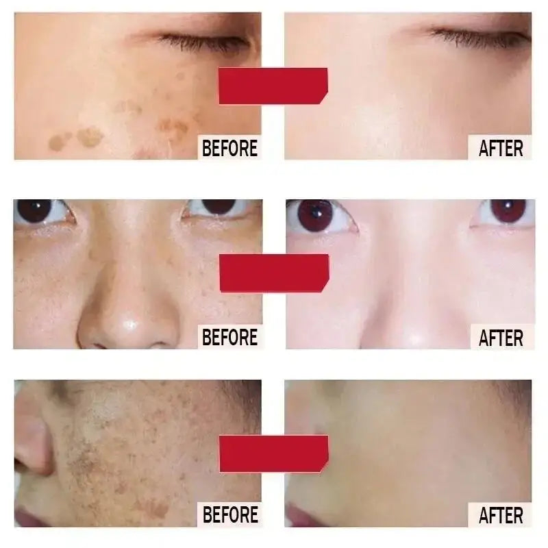 Whitening Freckles Face Cream