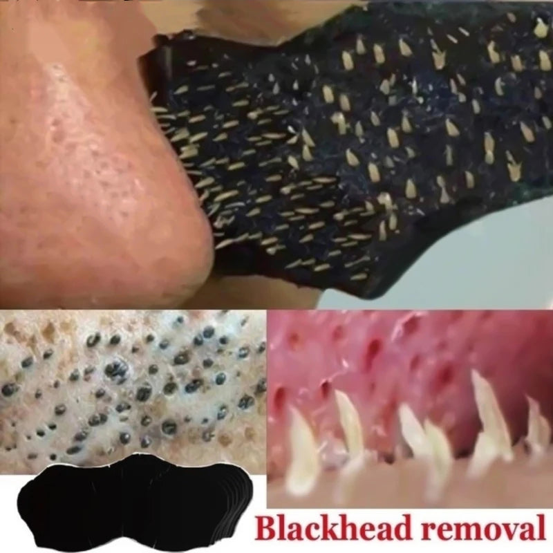 Nose Strips Blackheads & Acne Removal